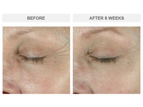Before and After ELASTIderm
