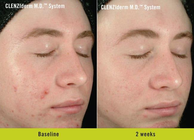 CLENZIderm Before and After