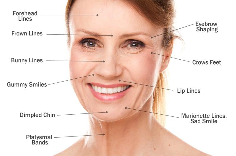 Botox Areas