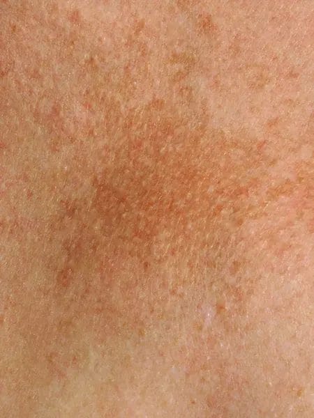 pigmentation on a patch of skin